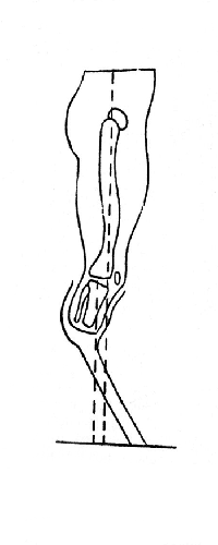 Рис. 8. Неуравновешенный центр тяжести при выносе стойки временного протеза вперед с целью устранения контрактуры коленного сустава (Лурье).