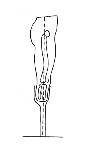 Рис. 8 а. Уравновешенный центр тежести во временном протезе после ампутации голени в верхней трети (Лурье).
