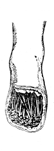 Рис. 29. Операция Лисфранка: форма и величина подошвенного лоскута. Кожа тыла стопы прикрывает края клиповидных костей (Фарабеф).