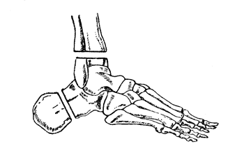 Рис. 44. Операция Пирогова - схема костных распилов (Эсмарх).
