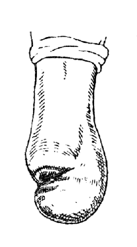 Рис. 48. осложнение после операции Пирогова: обычное смещение пяточного бугра при нагноении или недостаточности кожного лоскута и зашивании его с натяжением (собственное наблюдение).