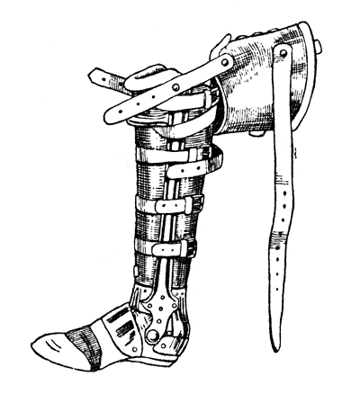 Рис. 49. Шинно-гильзовый протез для культи голени после операции Пирогова с металлической полой 