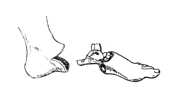 Рис. 60. Операция Ле-Фора - эскиз культи (до зашивания операционной раны) и удаляемой части стопы. Внутренняя сторона (Фарабеф).