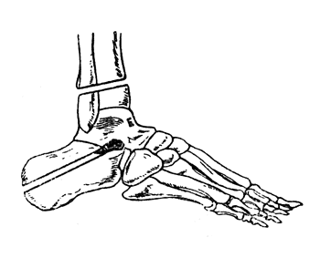 Рис. 59. Операция Ле-Фора - схема костных опилов (Эсмарх).