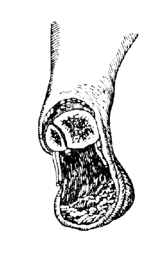 Рис. 68. Операция Сайма - пяточный лоскут изнутри (Эсмарх).