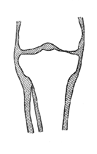 Рис. 87. Резекция головки малоберцовой кости для обеспечения «голенной» посадки в протезе. Схема рентгенограммы (собственное наблюдение).