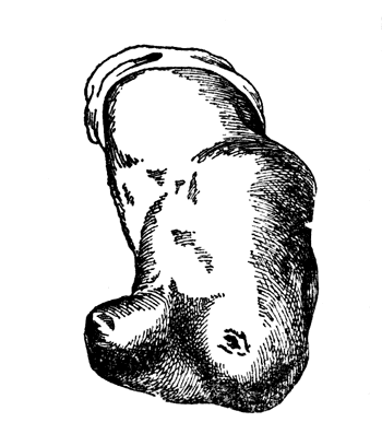 Рис. 91. Fibula valga при короткой культе голени (собственное наблюдение).