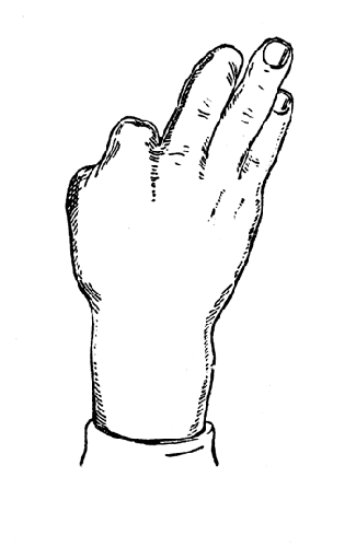 Рис. 105. Культи большого пальца после вычленения, II пальца после ампутации основной фаланги, III пальца после ампутации концевой фаланги (собственное наблюдение).