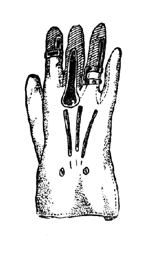 Рис. 106. Мягкий протез - лайковая перчатка с кольцами для культей второй и основной фаланг и II и IV пальцев кисти (собственный материал).