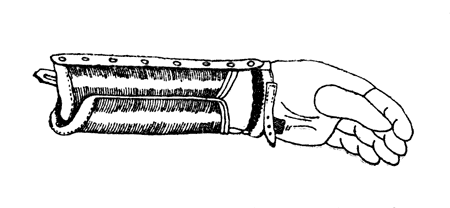 Рис. 109. Протез для кисти с использованием движений лучезапястного сустава. Пальцы и кисть резиновые.