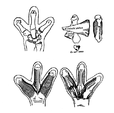 Рис. 130 и 131а. Схема системной реконструкции кисти после экзартикуляции пальцев (Шушков).