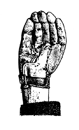 Рис. 142. Протез-кисть: приведение большого пальца протеза - активное схватывание между I и II пальцами (собственное наблюдение).