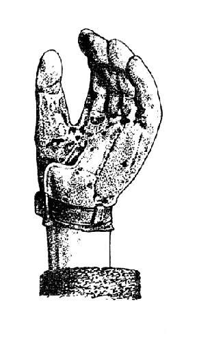 Рис. 143. Протез-кисть: отведение большого пальца протеза совершается активно первой пястной кистью после пластики (собственное наблюдение).