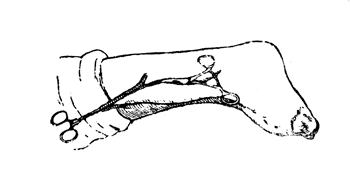 Рис. 174. Пластика по Филатову . II этап: отжимание одной ножки лоскута (собственое наблюдение).