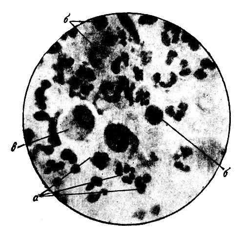  Рис. 3. Цитограмма (случай 8). Экссудат раны. а - микрофаги (значительное количество); б - полибласты (3-5-6 в поле зрения); в - макрофаги (1-2 в поле зрения) (после пятой перевязки с отваром эвкалипта). 