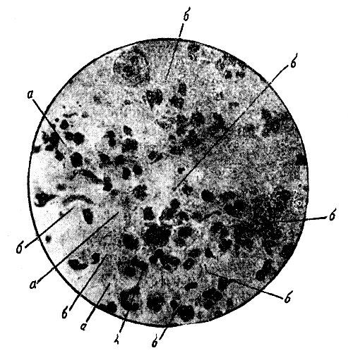 Рис. 6. Микрофотография с гнойного мазка (случай 21). а - диплококки; б - стрептококки (капсульные) (до действия отвара эвкалипта). 