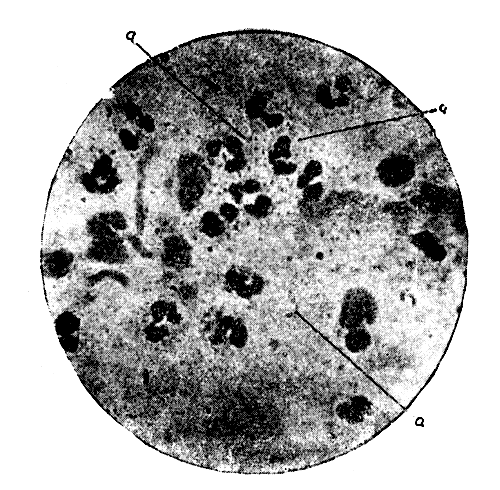 Рис. 8. Микрофотография с гнойного мазка (случай 23). а — кокки (обильное количество до действия отвара эвкалипта). 