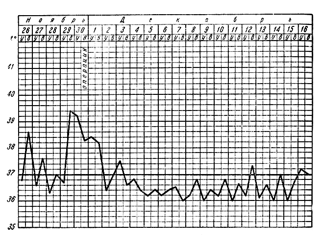 Рис. 20. Температурная кривая (случай 31). 