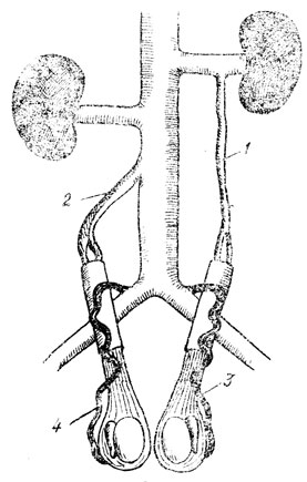 . 6.      : 1 - v. testicularis sinistra; 2 - v. testicularis dextra; 3 - v. cremasterica sinistra; 4 - v. cremasterica dextra