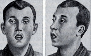 Рис. 2. Типичное выражение лица при аденоидах
