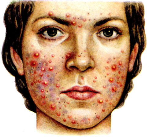  1. Acne vulgaris