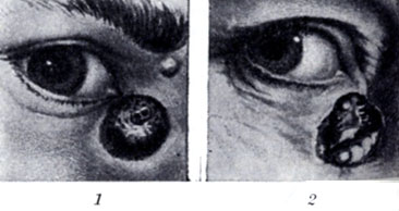 Рис. Базалиома кожи внутреннего угла глаза: 1 - узелковая форма; 2 - язвенная форма