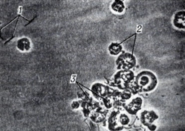 Рис. 1. Микроскопическая картина осадка мочи при бактериурии (светлопольное фазово-контрастное устройство): 1 - кишечная палочка, 2 - лейкоциты, 3 - аморфные фосфаты и трипельфосфаты