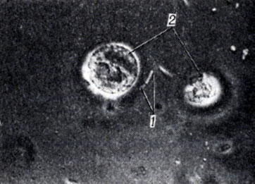 Рис. 2. Микроскопическая картина осадка мочи при бактериурии (темнопольное фазово-контрастное устройство) : 1 - кишечная палочка, 2 лейкоциты