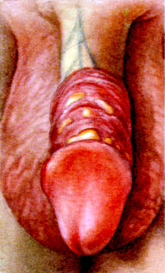 К ст. Баланит, баланопластит. Рис. 2. Гиперемия головки полового члена и внутреннего листка крайней плоти при баланопластите у ребенка