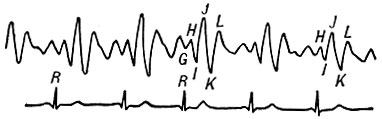Рис. 1. Нормальная баллистокардиограмма; нижняя кривая - электрокардиограмма I отв. (рис. 1-4 запись БКГ произведена датчиком Дока. Объяснение букв на БКГ см. в тексте)
