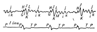 Рис. 2. Баллистокардиограмма больной 52 лет с гипертонической болезнью II стадии, блокадой левой ножки предсердно-желудочкового пучка (Гиса) и атрио-вентрикулярной блокадой III степени. II степень патологических изменений: укорочена волна I, глубокие волны K. Предсердные комплексы i, j, k следуют за зубцом P электрокардиограммы (нижняя кривая)