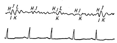 Рис. 3. Баллистокардиограмма больного 60 лет. Атеросклероз коронарных артерий, стенокардия. III степень патологических изменений: слитные волны H и I на выдохе, значительная изменчивость всех интервалов H - K от 0,17 до 0,28 сек. Нижняя кривая - электрокардиограмма I отв