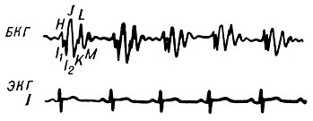 Рис. 4. Баллистокардиограмма больной с комбинированным митральным пороком сердца в стадии компенсации. I степень патологических изменений. Расщепление волны I, отрезка KL (по Тумановскому и Сафонову)